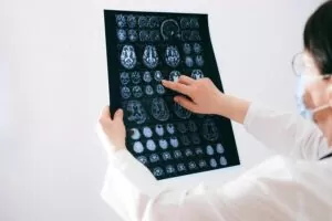 What is Transcranial Magnetic Stimulation (TMS) and how is it used to treat depression?